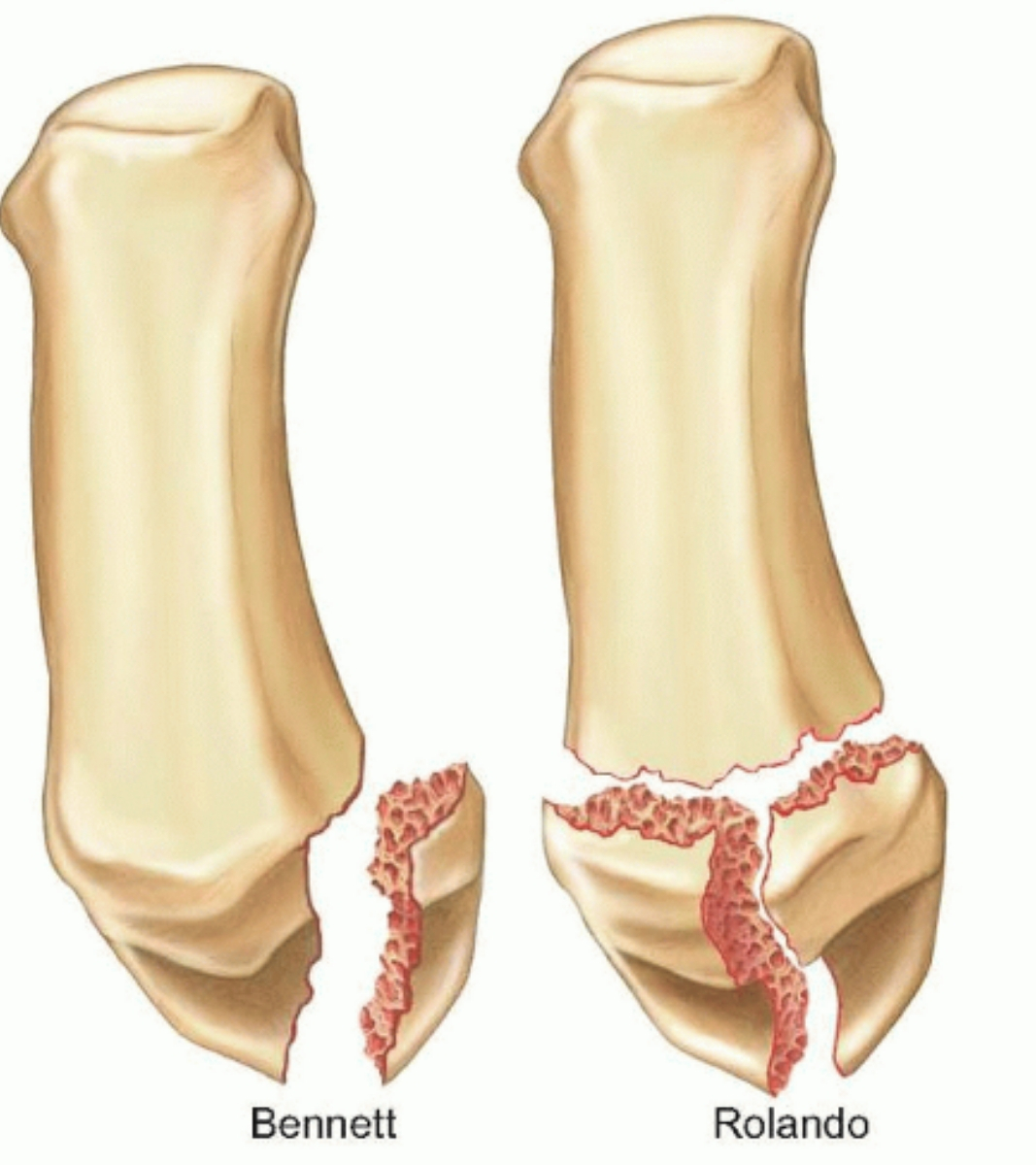 Thumb fracture, thumbe care and treatment, Thumb fracture surgeons, causes of thumn fractures, symtoms of thumb fractures
