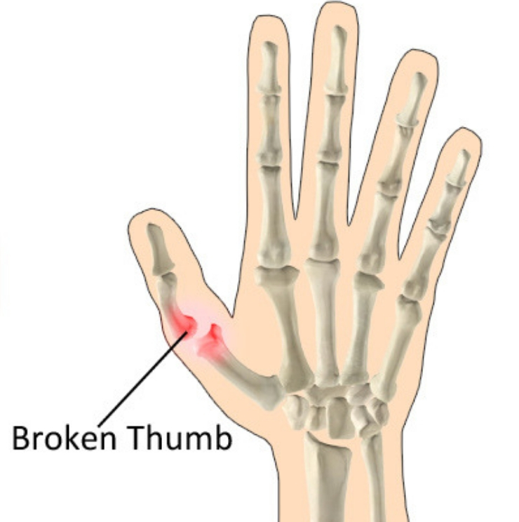 Thumb fracture, thumbe care and treatment, Thumb fracture surgeons, causes of thumn fractures, symtoms of thumb fractures