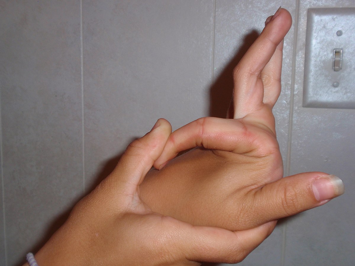Mallet finger, baseball fingers, treatment of mallet fingers, causes of mallet fingers