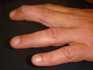 Mallet finger, baseball fingers, treatment of mallet fingers, causes of mallet fingers