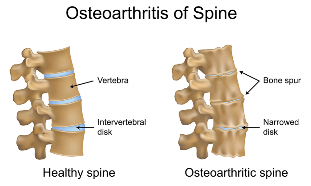 Spinal arthritis, Spine doctors in Kenya, spine centre in nairobi, Osteoarthritis of the spine, Osteoarthritis of the spine, arthritis treatment in kenya,