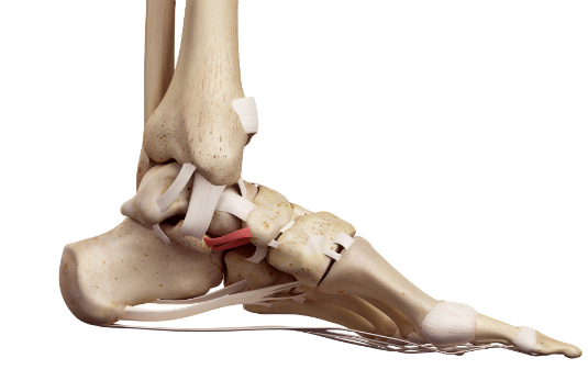 Calcaneal Fractures, Calcaneal fracture care in Kenya, Heel bone fractures treatment