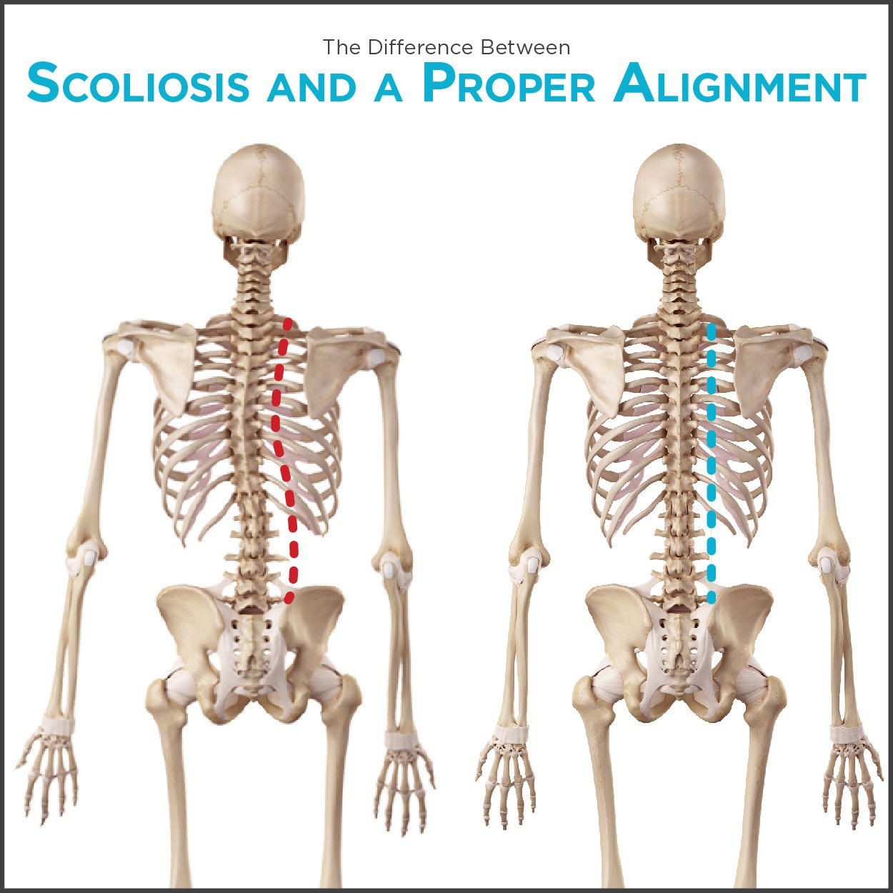 scoliosis and kyphosis