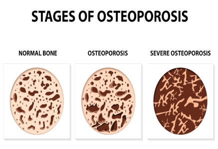 Preventing osteoporosis, hip bursitis treatment in Kenya, Dislocated shoulder treatment in Kenya, Day surgery care in Kenya, Top orthopaedic surgeons in Kenya, orthopedic surgeon in Nairobi, Kenya, Nairobi spine and orthopaedic centre, Bone tumor treatment, Bone and joint infection clinic, knee joint treatment, Knee surgeon in Kenya, hip surgeon in Kenya, hip specialist, foot and ankle surgeon, Neck pain treatment, back pain treatment in Kenya , spinal cord injury in Kenya, neck specialist in Kenya, Neck, back and spine surgeon in Kenya, hand and wrsit specialist, sports medicine in Kenya, sports injury treatment, athritis treatment in Kenya, Fractures treatment, pediatric orthopedics in Nairobi, orthopaedic centre in Nairobi, orthopaedic centre in Kenya