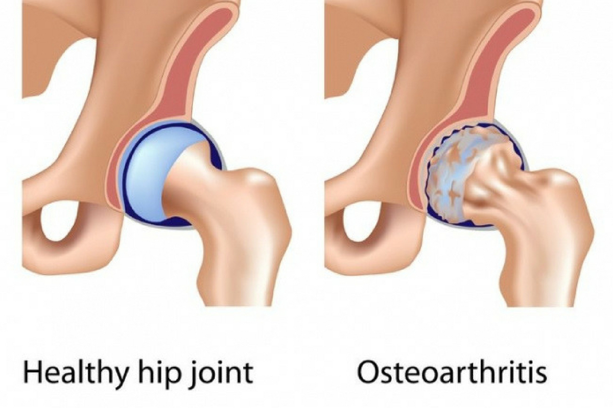 Osteoarthritis of the hip, Hip arthritis,