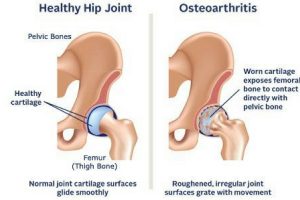 Partial hip replacement surgery, Inflammatory arthritis of the hip, Hip joint care, Dislocated shoulder treatment in Kenya, Day surgery care in Kenya, Top orthopaedic surgeons in Kenya, orthopedic surgeon in Nairobi, Kenya, Nairobi spine and orthopaedic centre, Bone tumor treatment, Bone and joint infection clinic, knee joint treatment, Knee surgeon in Kenya, hip surgeon in Kenya, hip specialist, foot and ankle surgeon, Neck pain treatment, back pain treatment in Kenya , spinal cord injury in Kenya, neck specialist in Kenya, Neck, back and spine surgeon in Kenya, hand and wrsit specialist, sports medicine in Kenya, sports injury treatment, athritis treatment in Kenya, Fractures treatment, pediatric orthopedics in Nairobi, orthopaedic centre in Nairobi, orthopaedic centre in Kenya , Nerve blocks, Removal or repair of damaged cartilage, Osteaoarthritis of the hip, Complex regional pain syndrome,CRPS, Reflex sympathetic dystrophy treatment in Kenya, Osteaoarthritis of the hip, Perthes disease, hip fractures