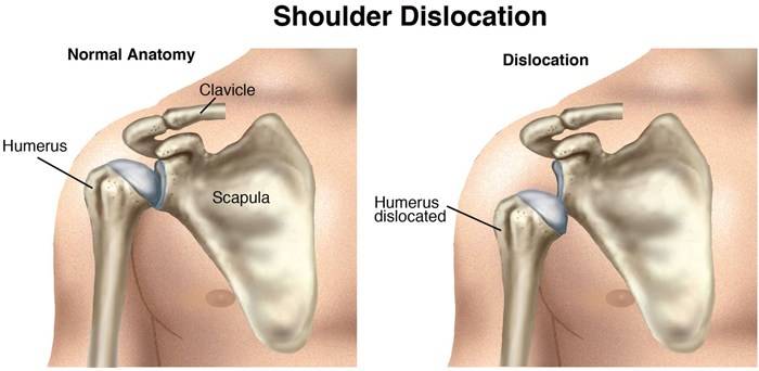 Dislocated shoulder