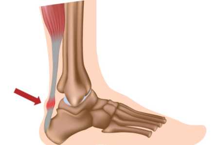 Achilles Tendonitis, Achilles tendonitis treatment, Achilles Tendonitis care in Kenya