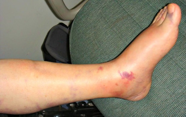 Ankle sprains treatment in Kenya, Knee doctors in kenya
