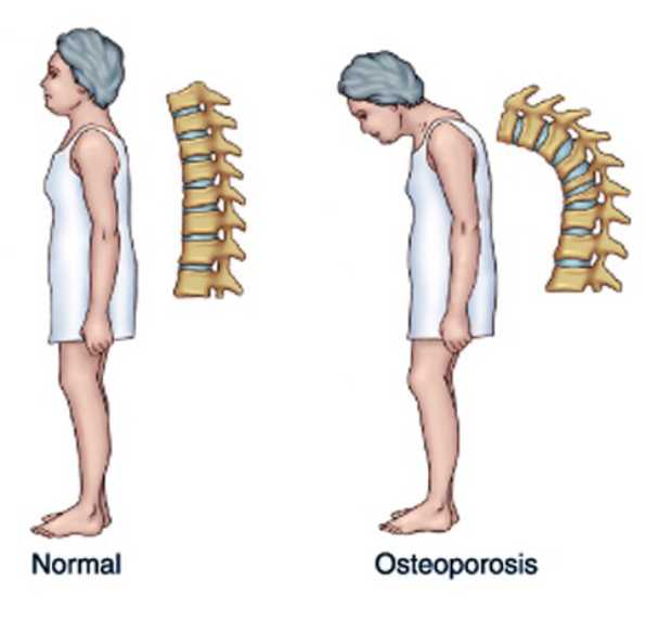 Osteoporosis, spine surgeon in Kenya, spine doctors in Kenya, osteoporosis treatment in Kenya