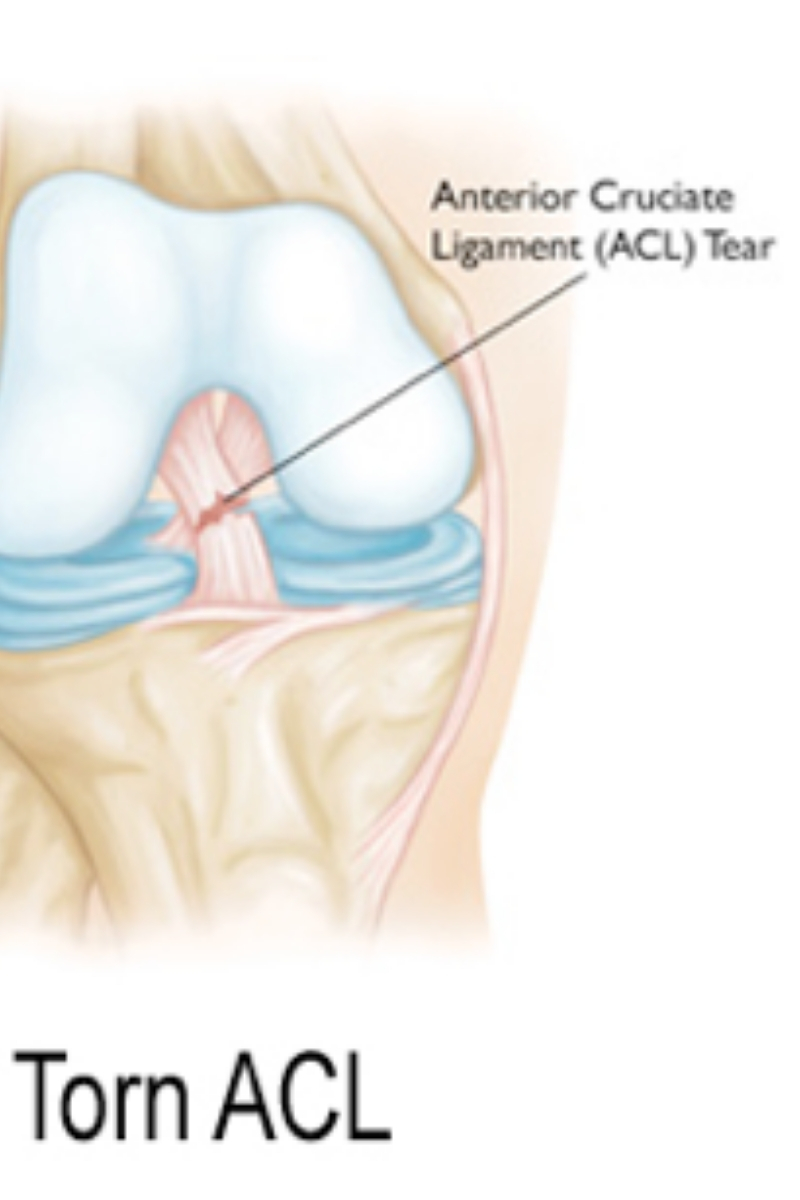 ACL, ACLInjuries, ACL Treatment, ACL Recovery, ACL Surgery, Anteror Cruciate Ligament