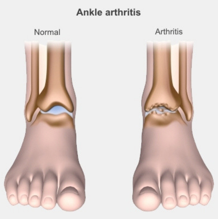 Foot and ankle arthritis, Arthritis treatment in Kenya, foot surgeon, ankle surgeon, Golfer's elbow treatment in kenya, Golfer's elbow care in Nairobi, Golfer's elbow surgeon doctors