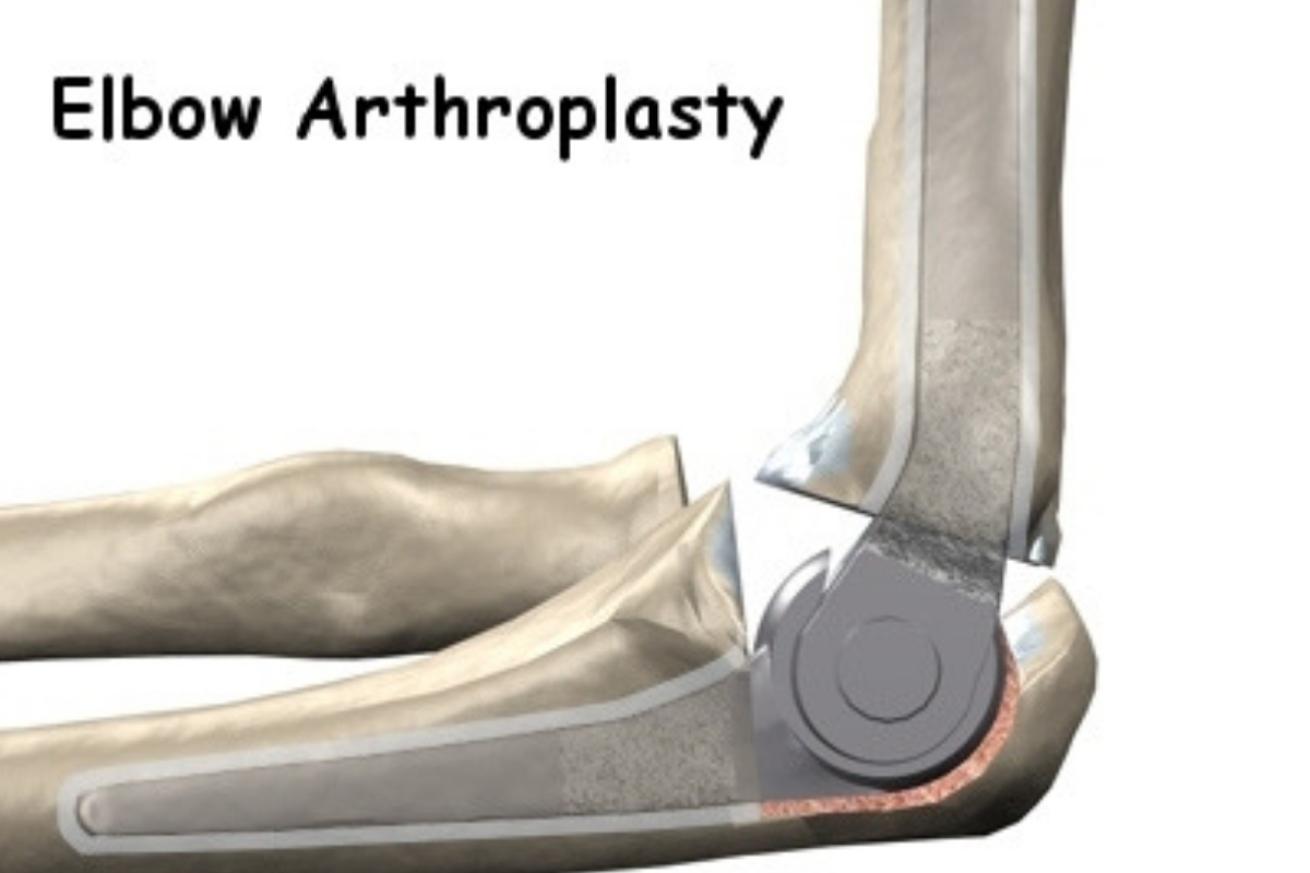 Osteoarthritis of the elbow