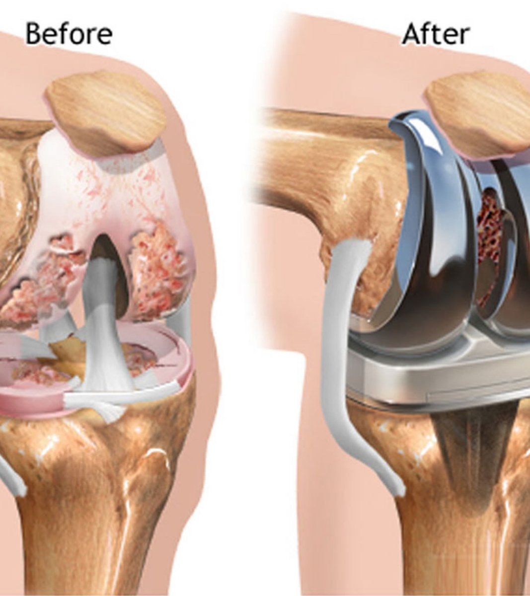 Revision knee replacement