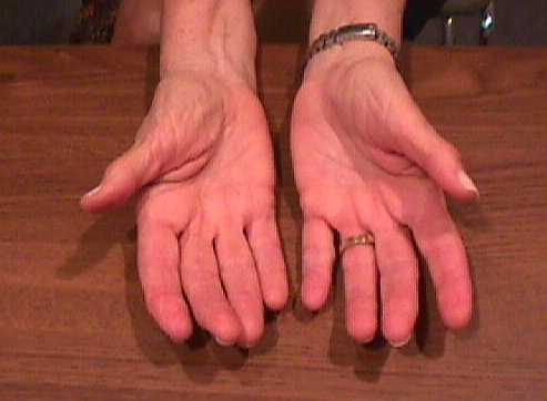Basilar joint arthritis, Treatment of Basilar joint Arthritis,