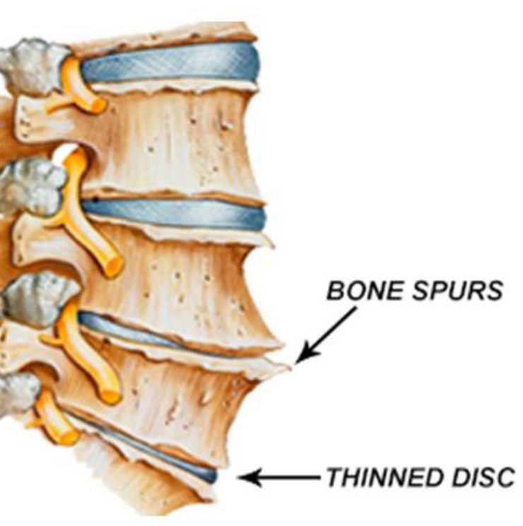 Spinal bone spurs, spine doctors in Kenya, spine surgeons in Kenya, spine centre in Nairobi