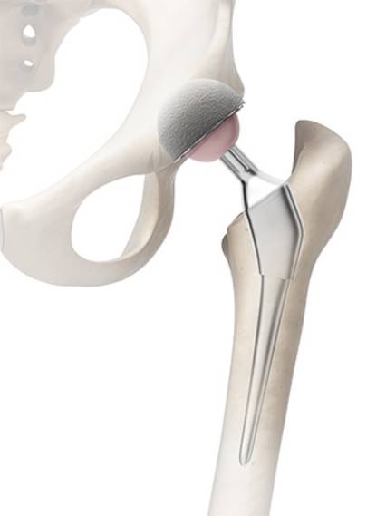Cemented hip
