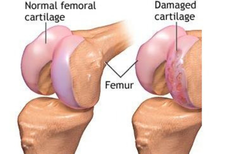 Removal or repair of damaged cartilage