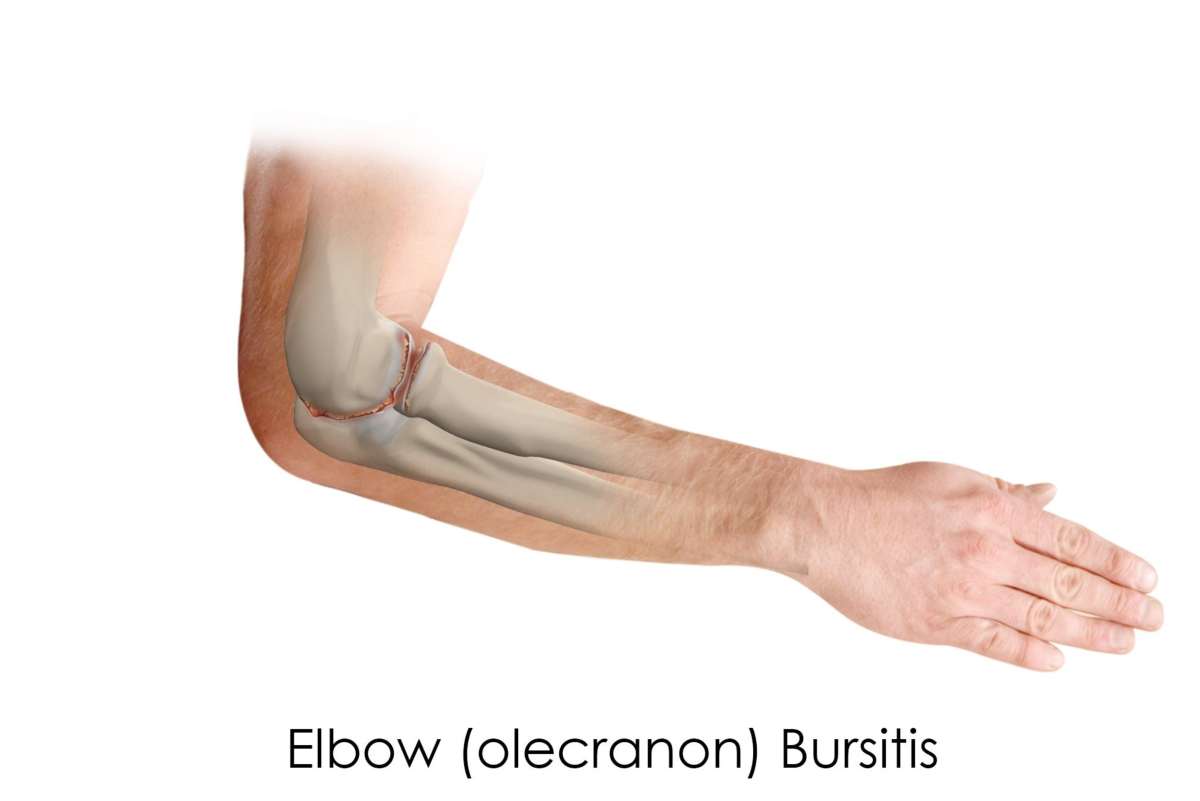 Elbow bursitis