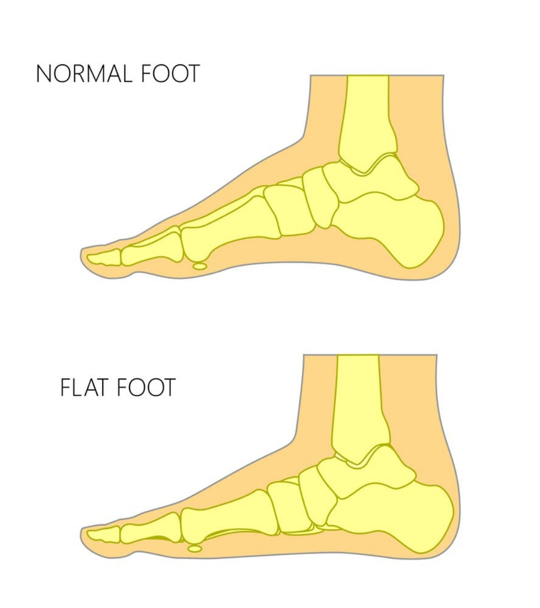 Adult acquired flatfoot,