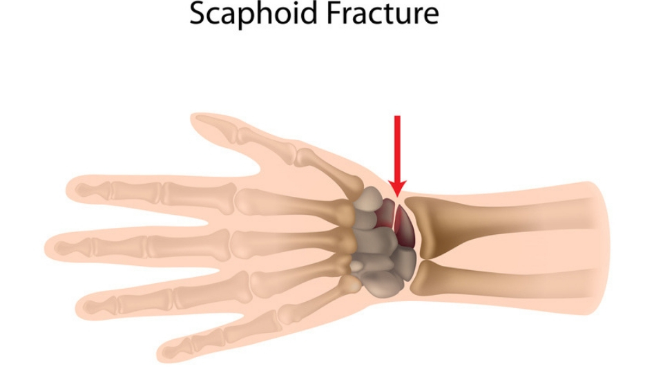 Scaphoid fractures of the hand and the wrist