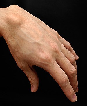 Ganglion cyst ,Ganglion cyst of the hand and the wrist, treatment of ganglion cyst in Kenya, hand doctors in Kenya