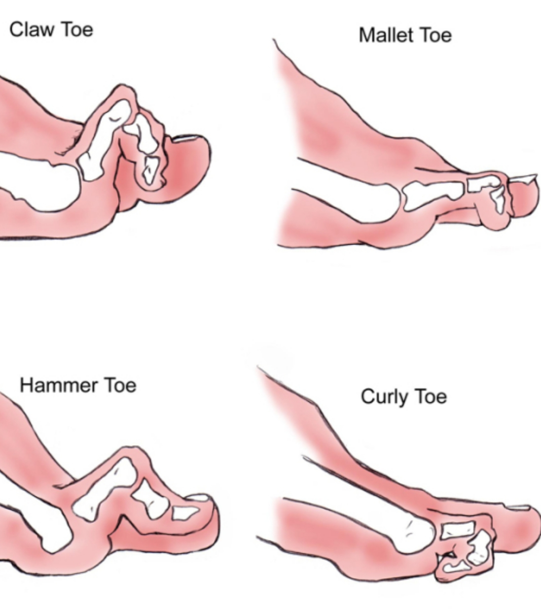 Hammer Claw and mallet toes