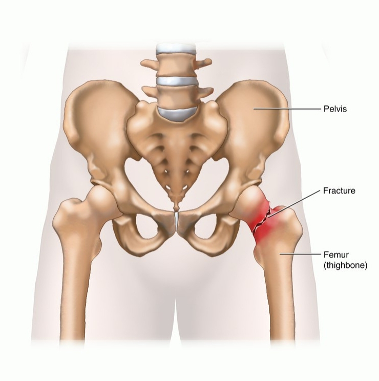Osteonecrosis of the hip, hip fractures