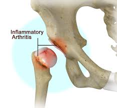 Inflammatory arthritis of the hip, Hip joint care, Dislocated shoulder treatment in Kenya, Day surgery care in Kenya, Top orthopaedic surgeons in Kenya, orthopedic surgeon in Nairobi, Kenya, Nairobi spine and orthopaedic centre, Bone tumor treatment, Bone and joint infection clinic, knee joint treatment, Knee surgeon in Kenya, hip surgeon in Kenya, hip specialist, foot and ankle surgeon, Neck pain treatment, back pain treatment in Kenya , spinal cord injury in Kenya, neck specialist in Kenya, Neck, back and spine surgeon in Kenya, hand and wrsit specialist, sports medicine in Kenya, sports injury treatment, athritis treatment in Kenya, Fractures treatment, pediatric orthopedics in Nairobi, orthopaedic centre in Nairobi, orthopaedic centre in Kenya , Nerve blocks, Removal or repair of damaged cartilage, Osteaoarthritis of the hip, Complex regional pain syndrome,CRPS, Reflex sympathetic dystrophy treatment in Kenya, Osteaoarthritis of the hip, Perthes disease, hip fractures