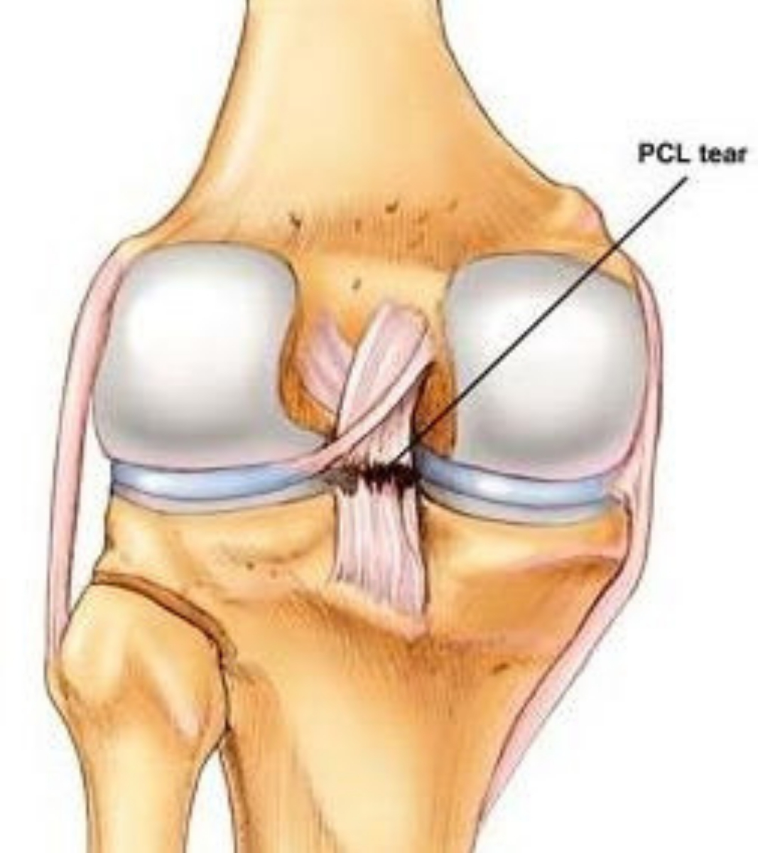 PCL, PCL treatment, PCL Surgery, PCL recovery, PCL tears, PCL managemnt, Knee doctors, Knee Specialist, Posterior Cruciate Ligament