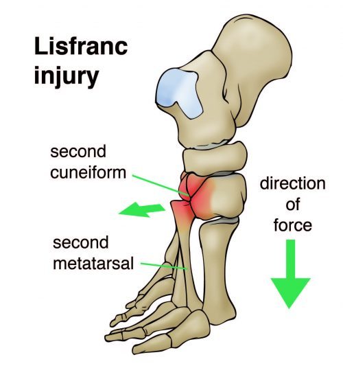 Lisfranc injury, Lisfranc Fracture, Midfoot sprain,lisfranc fracture treatment, midfoot sprain care and treatment