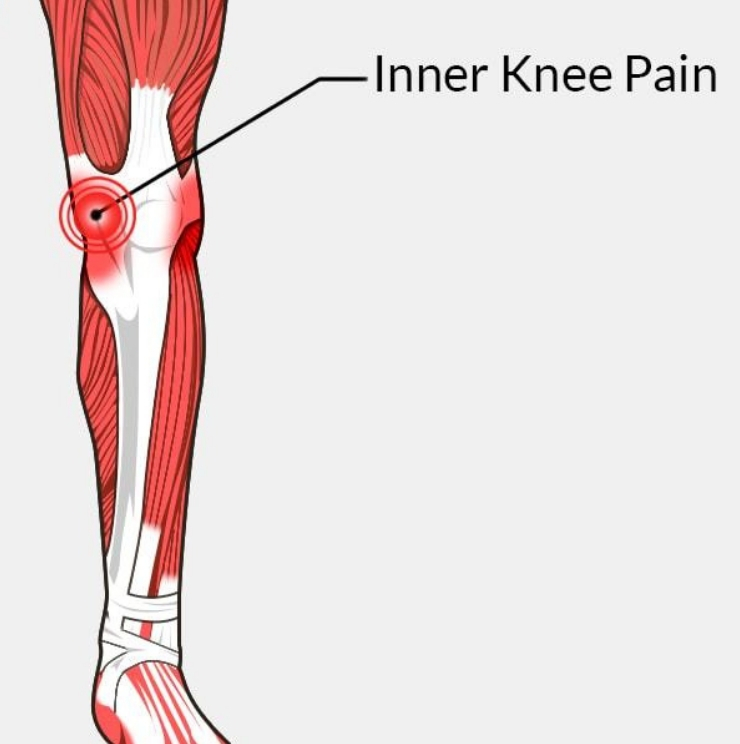 Knee pain, Knee pain causes, knee pain symptoms, knee pain treatment, Unstable kneecap, unstable kneecap treatment, Kneecap surgery, loose kneecap exercices, Patella intability
