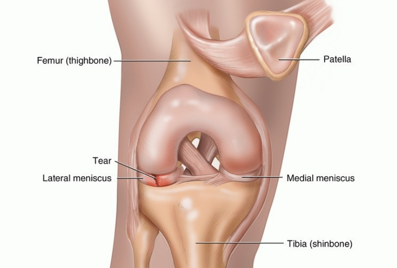 Discoid meniscus injuries