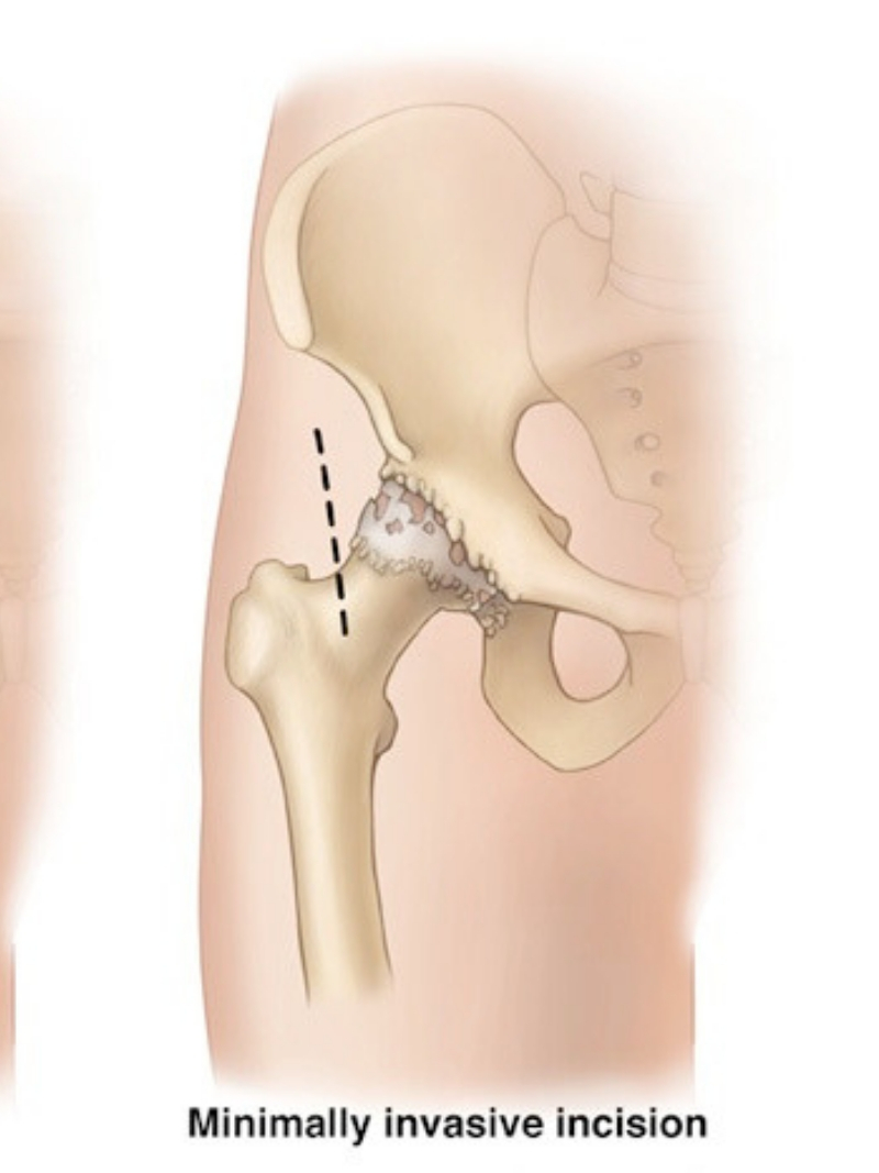 Minimally invasive hip surgery