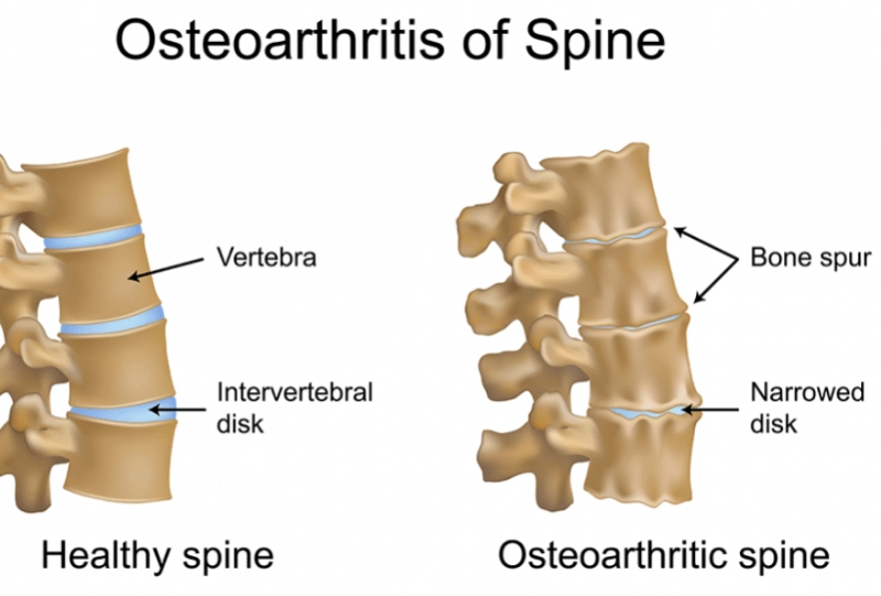 degenerative disc treatment in kenya,nairobi spine and orthopaedic centre,degenerative disc specialist in kenya