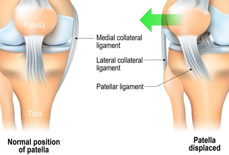 Unstable kneecap, unstable kneecap treatment, Kneecap surgery, loose kneecap exercices, Patella intability