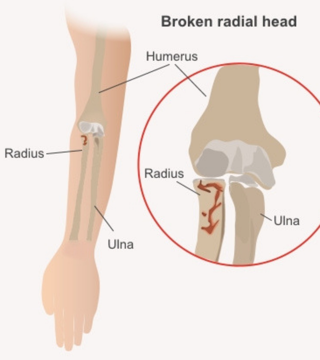 Elbow fractures