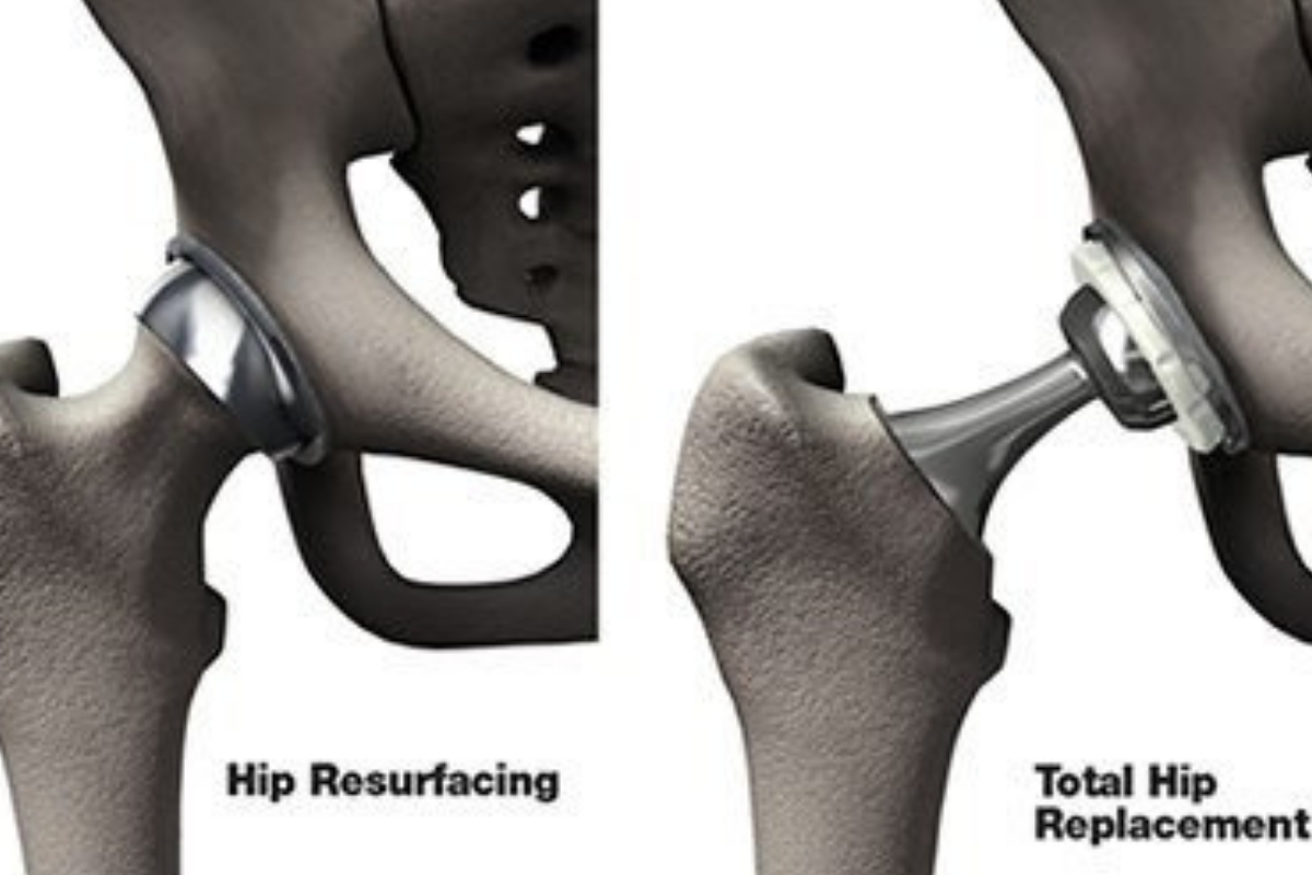 Hip Resurfacing, Hip replacement surgery in Kenya