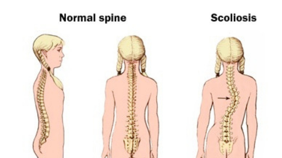 spinal deformities, orthopaedic surgeons in kenya,spinal deformities treatment in kenya,spinal deformities specialist in kenya nairobi spine orthopaedic centre
