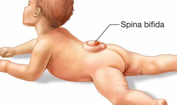 Spinal bifida, treatment of spinal bifida in Kenya, spine doctors in Nairobi