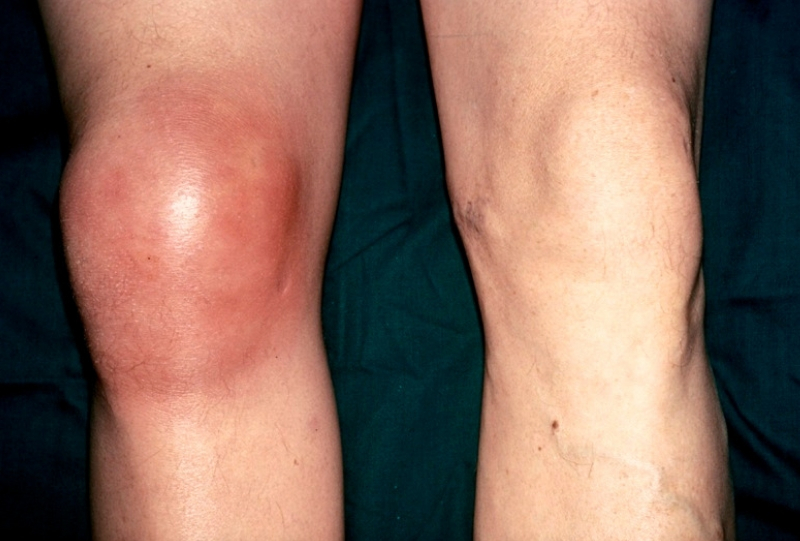 Osteonecrosis of the Knee, Kneecap bursitis