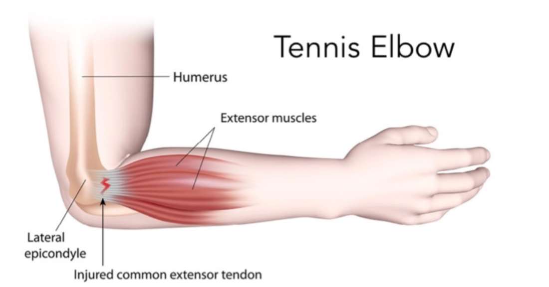 Tennis elbow (Lateral Epicondylitis)