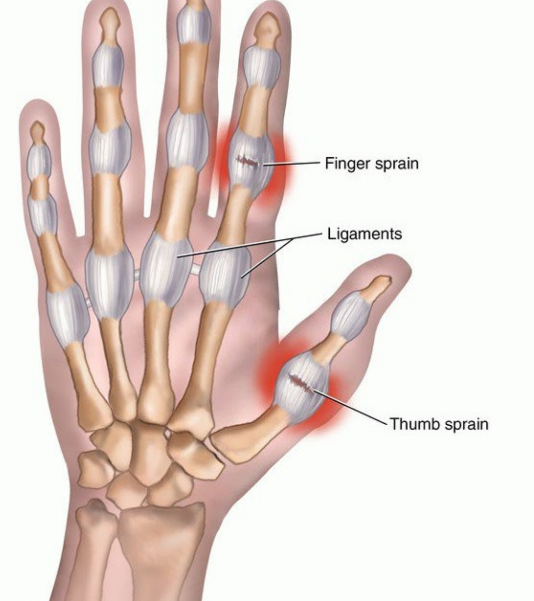 Sprained thumb, Thumb sprain, sprained thumb, causes of sparined thumb, symptoms of spained thumbs, care for sprained thumbs