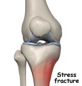 Stress fracture,Stress fracture care, stress fracture treatment, stress fracture causes