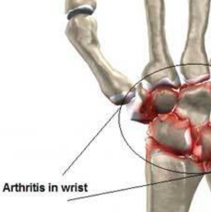 Wrist arthritis, arthritis treatment in Kenya, Wrist surgeons, Causes of arthtritis, wrist doctors
