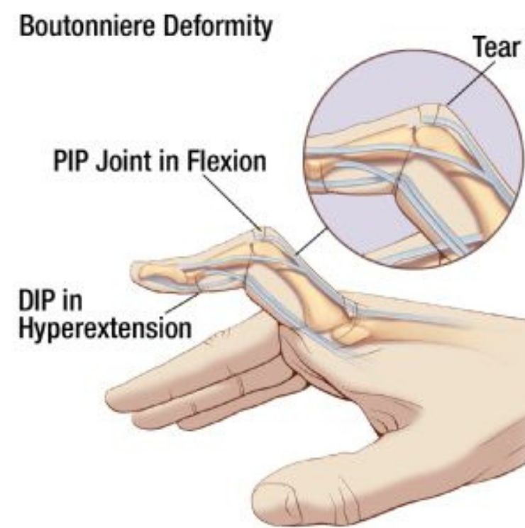 Boutonniere deformity, hand surgeons, Hand surgery, Splints