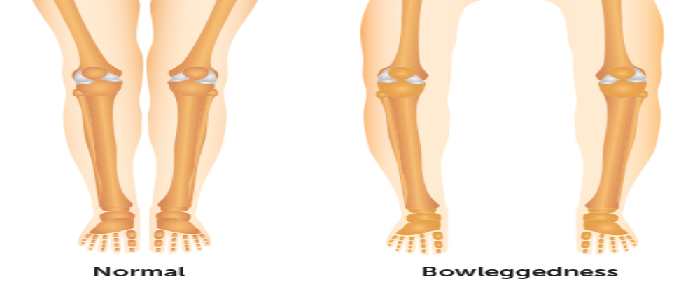 bowlegs in adults treatment in Kenya, Nairobi spine and orthopaedic centre
